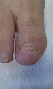Nail Reconstruction at the foot clinic redditch