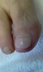 Nail Reconstruction at the foot clinic redditch